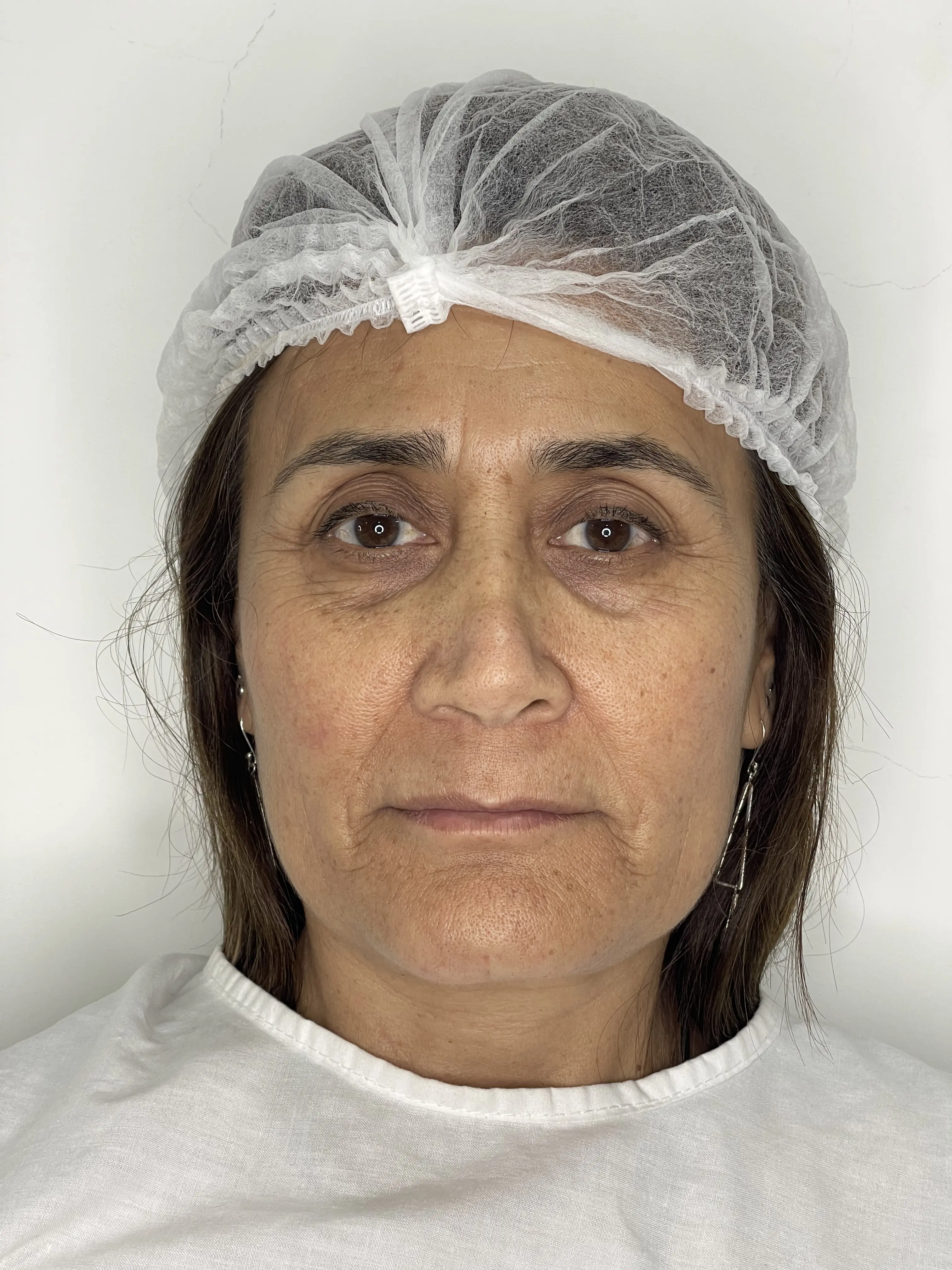 Antes de Lifting Facial No Quirúrgico