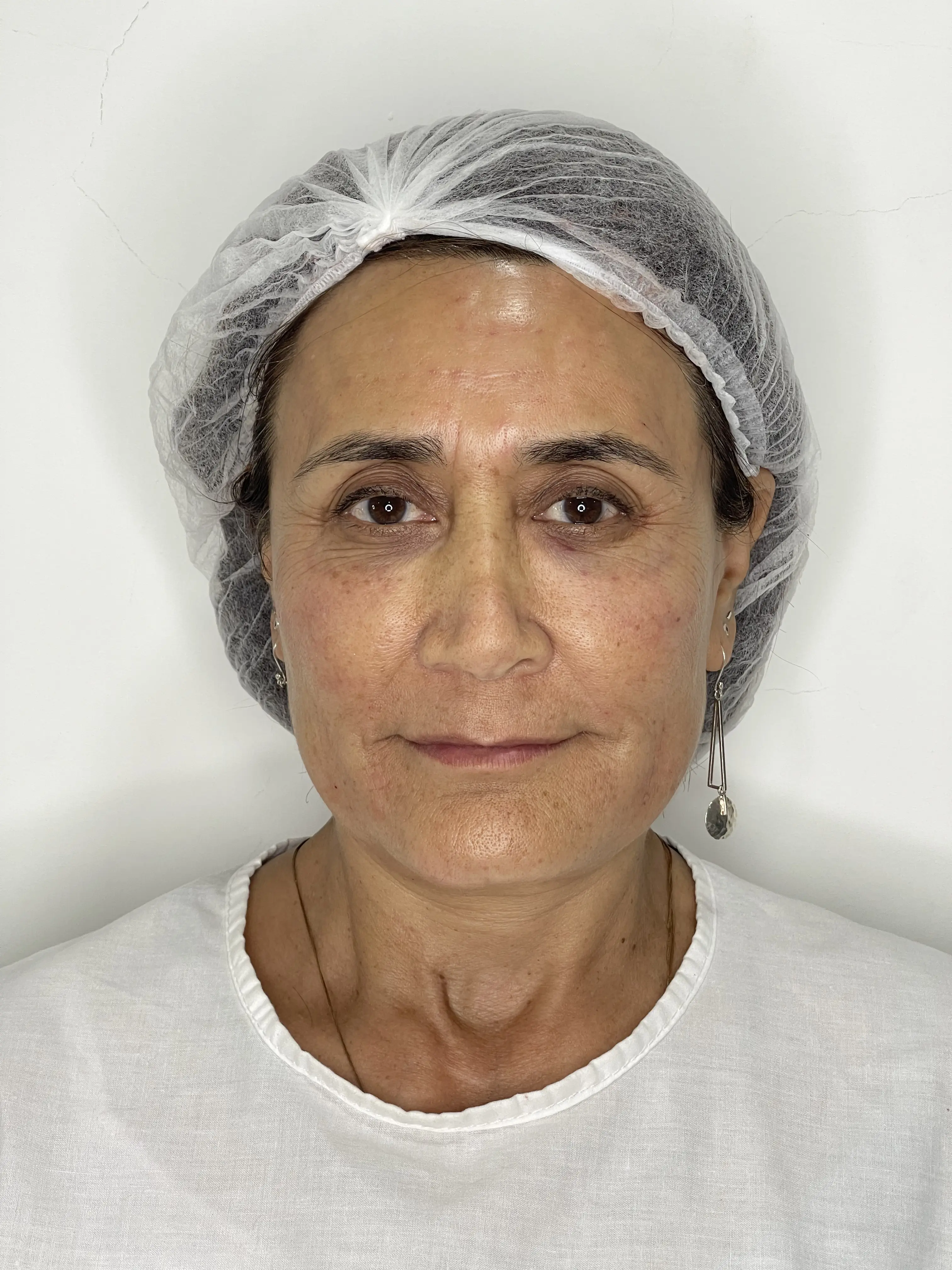 Después de Lifting Facial No Quirúrgico
