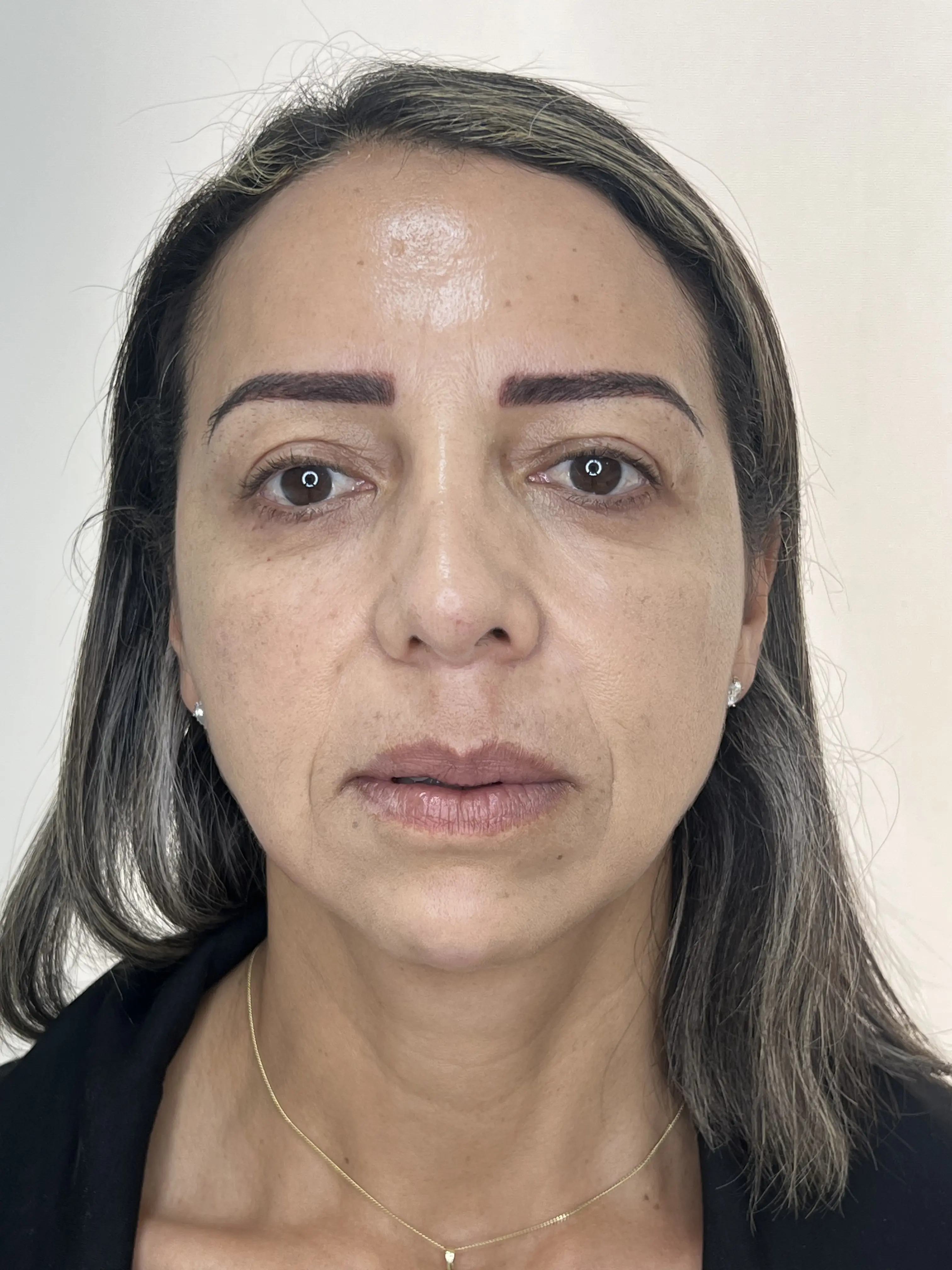 Después de Rellenos Faciales